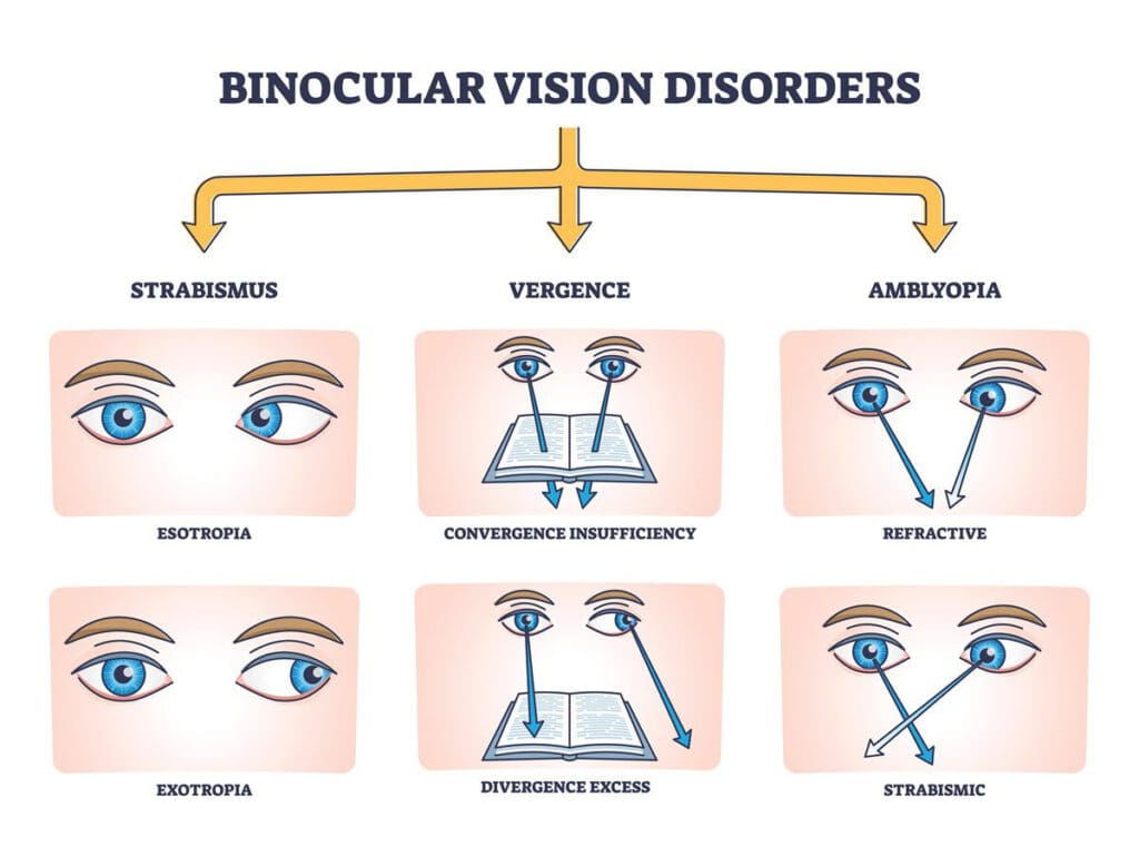 Binocular Vision Disorders