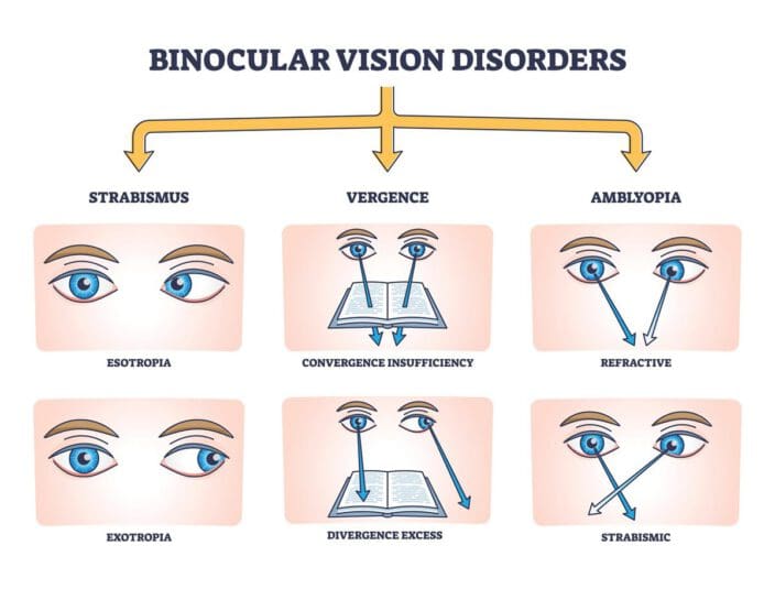 Tunnel Vision (Peripheral Vision Loss): Symptoms, Causes, Treatments