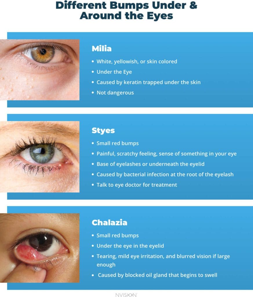 how to get rid of small bumps on eyes