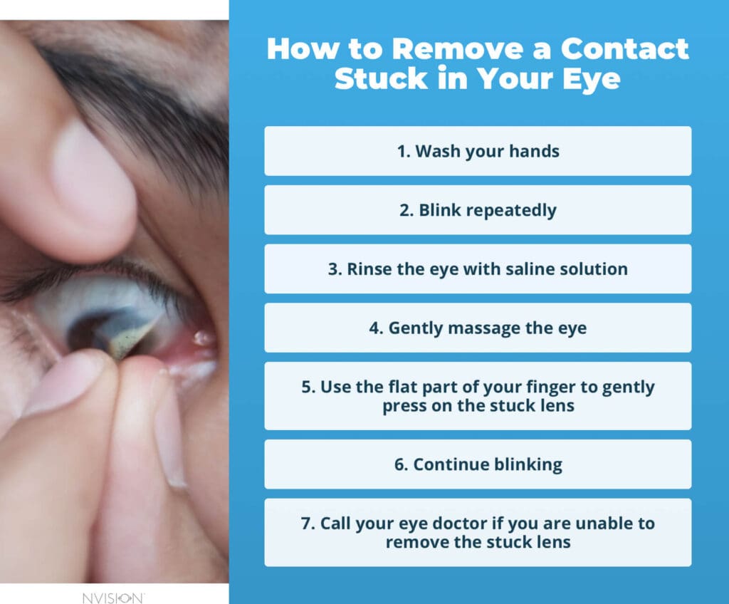 How to Remove a Contact Stuck in Your Eye