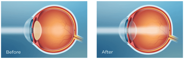 PanOptix Trifocal Lenses (IOL) for Cataracts: Explained – NVISION Eye  Centers