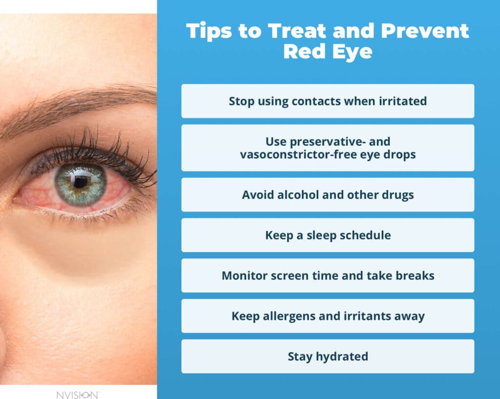 Tips to Treat and Prevent Red Eye