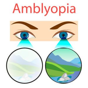 vector of ambylopia