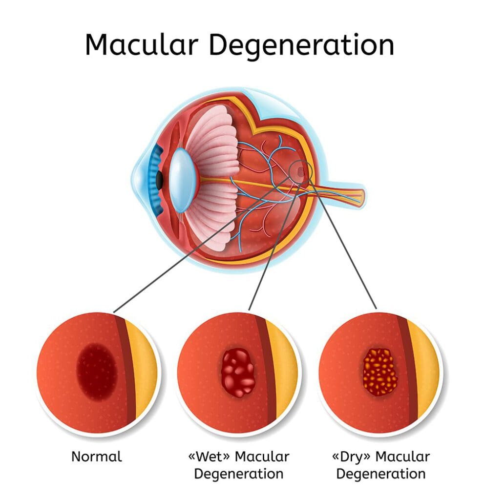 diagram of Macular Degeneration