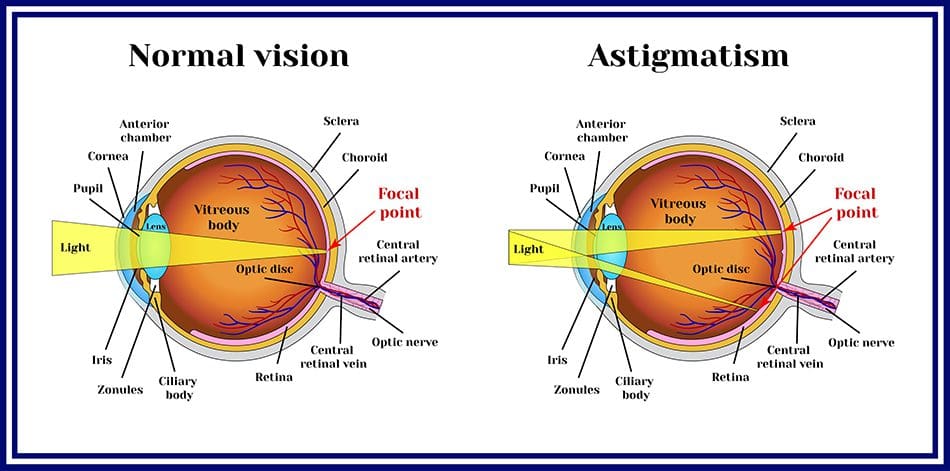 astigmatism vs normal vision graphic