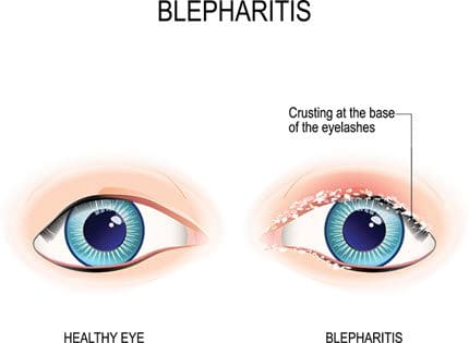 blepharitis diagram