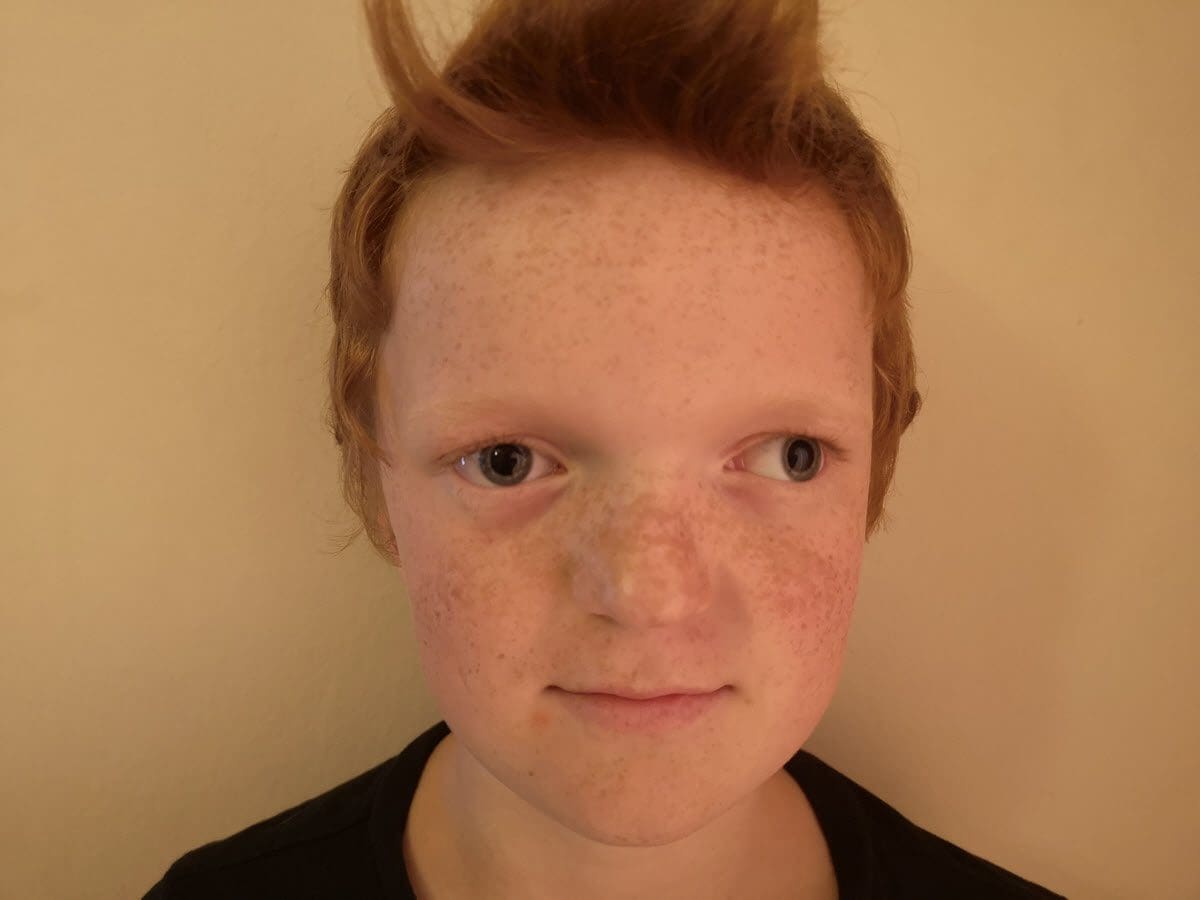 Exotropia (Eye Misalignment) Causes, Types and Treatment