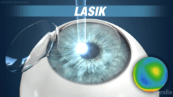 lasik eye