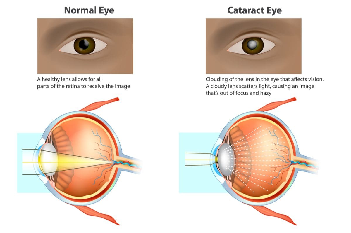 cataract eye vs normal eye