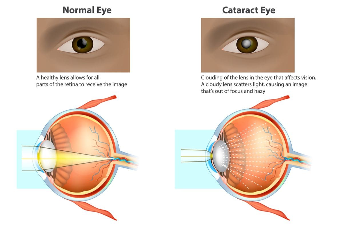 Cataracts Signs Symptoms Causes Diagnosis Treatment
