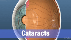 What are Cataract Symptoms?