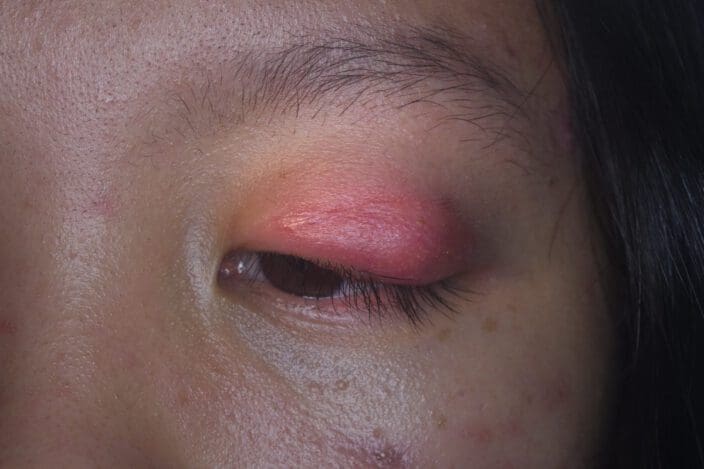 periorbital cellulitis contagious