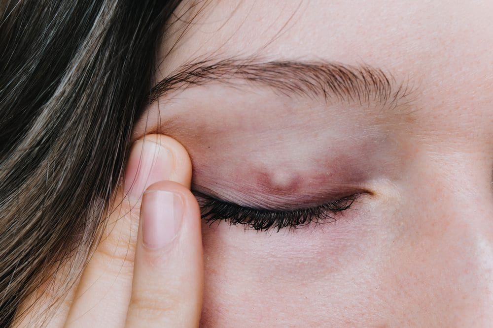 young woman with a bump on eyelid