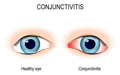 conjunctivitis vs normal eye
