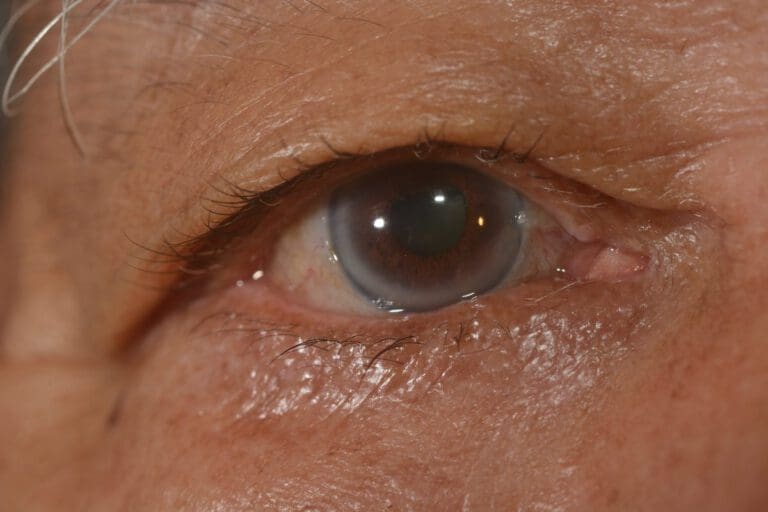 Corneal Arcus Causes & Treatment Options NVISION Eye Centers