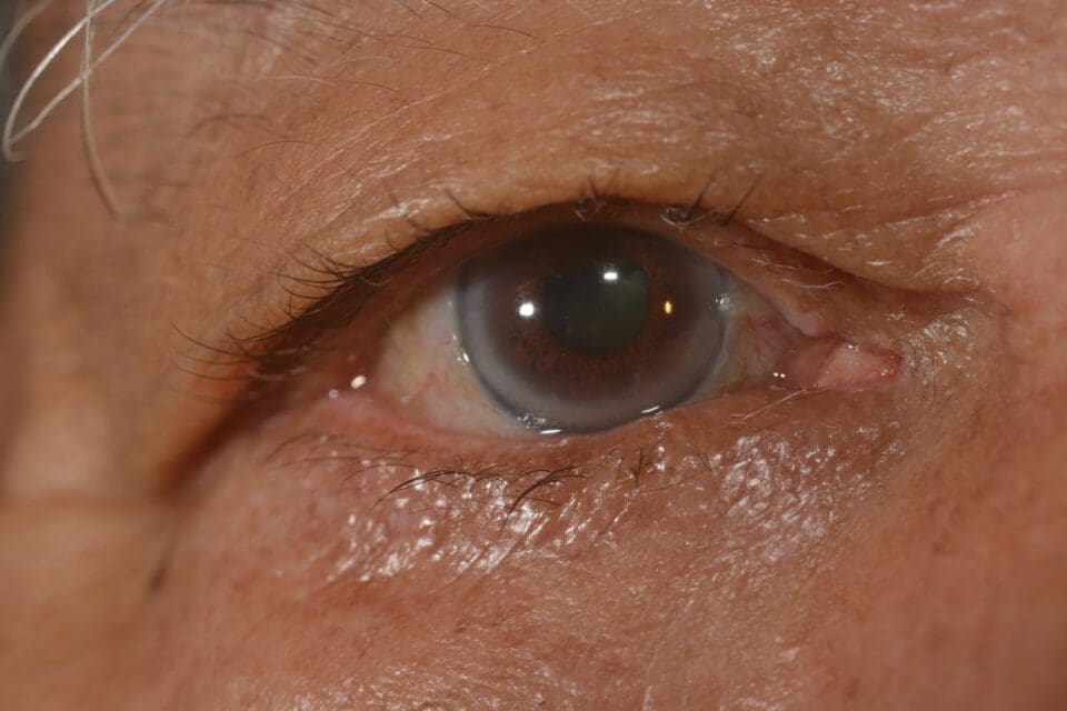 Corneal Arcus Causes & Treatment Options NVISION Eye Centers