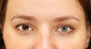 woman with heterochromia
