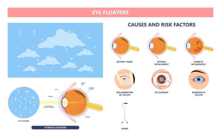 Eye Floaters And Flashes Separating Harmless Symptoms From Serious 