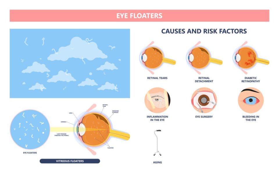 Eye Floaters Causes & How to Get Rid of Them for Good NVISION