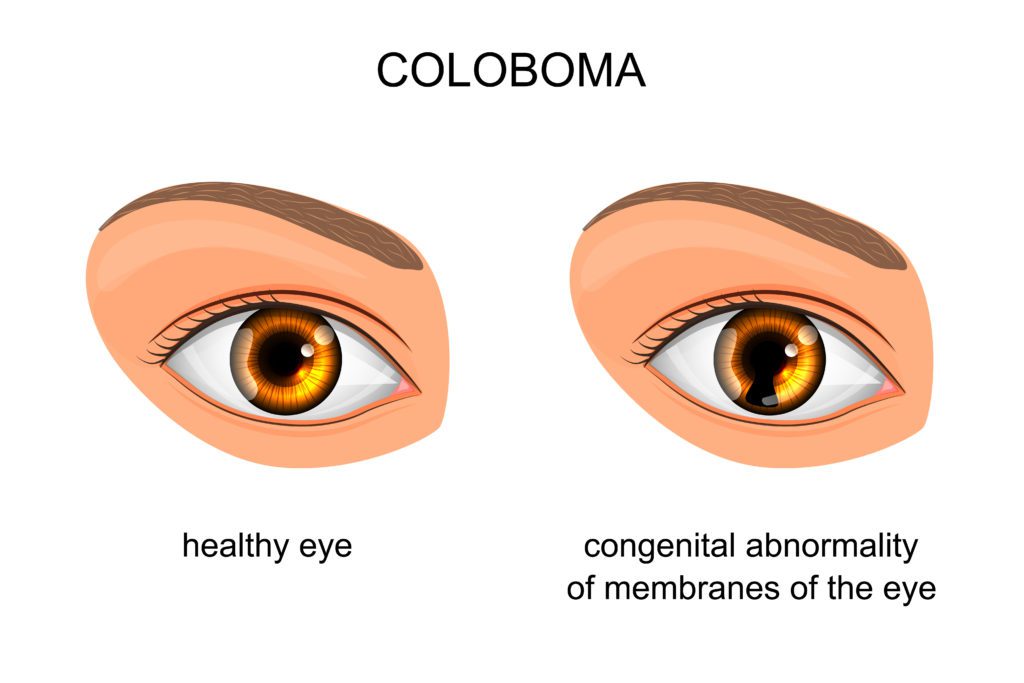 coloboma of the eye