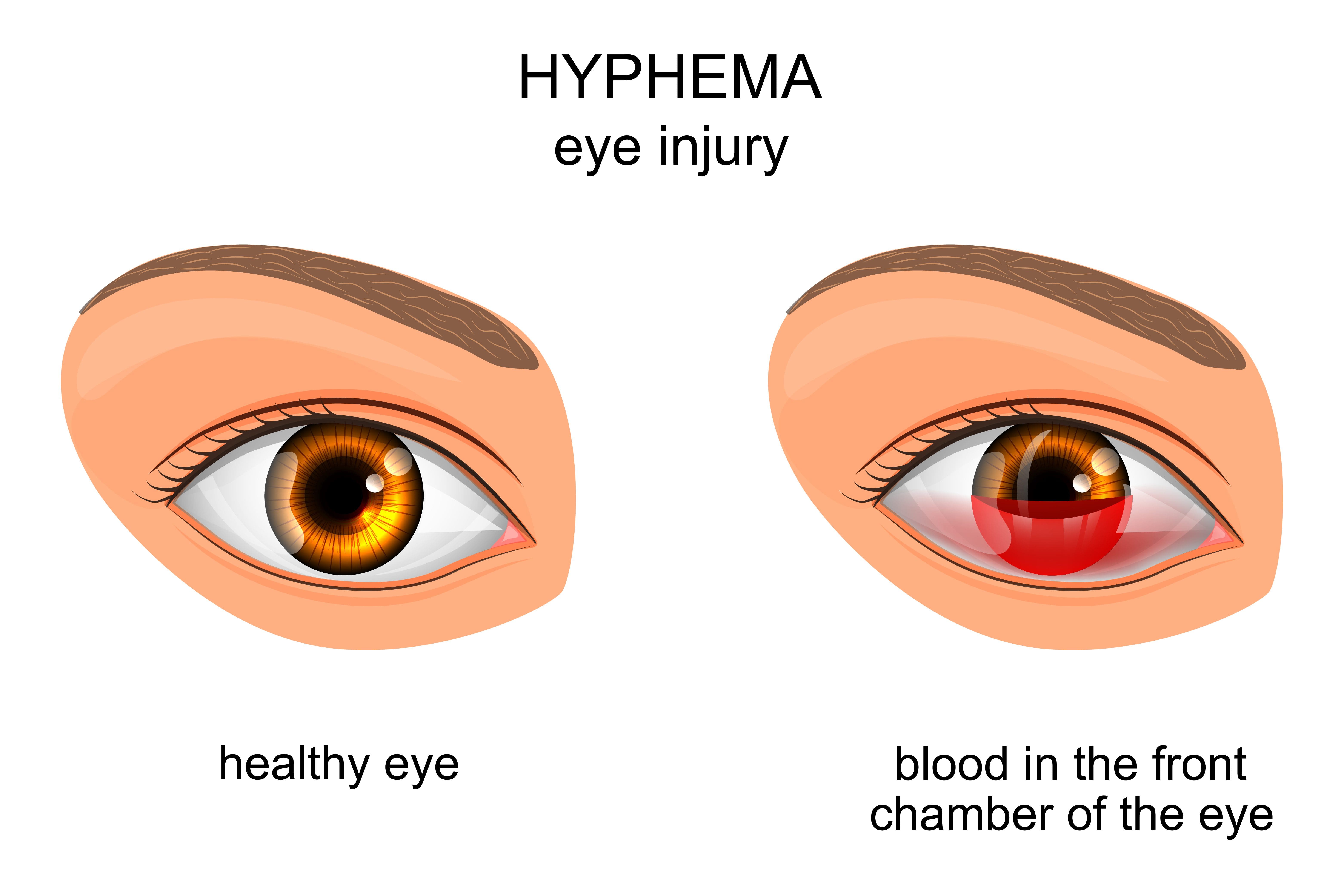 does hyphema in dogs go away