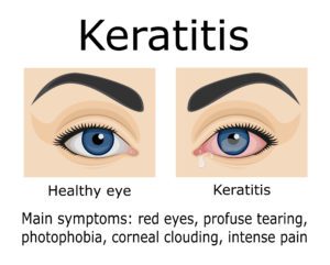 keratitis