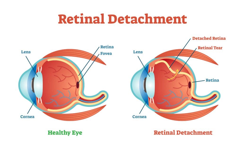 Retina - American Academy of Ophthalmology