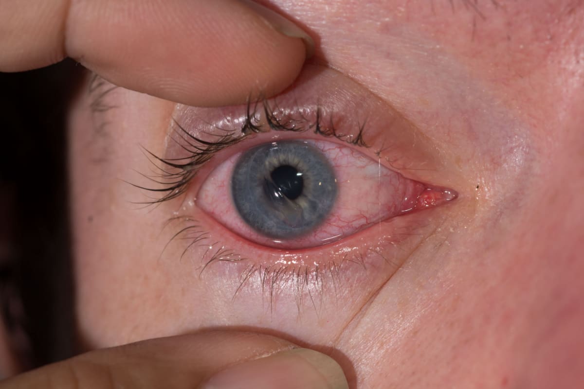 How to Tell if You Have a Scratched Cornea (& What to Do)