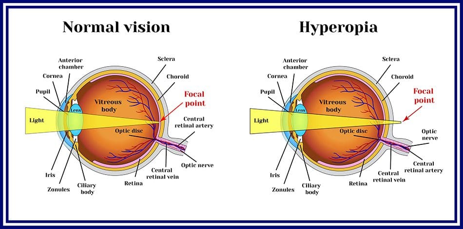 hyperopia vs. normal vision graphic