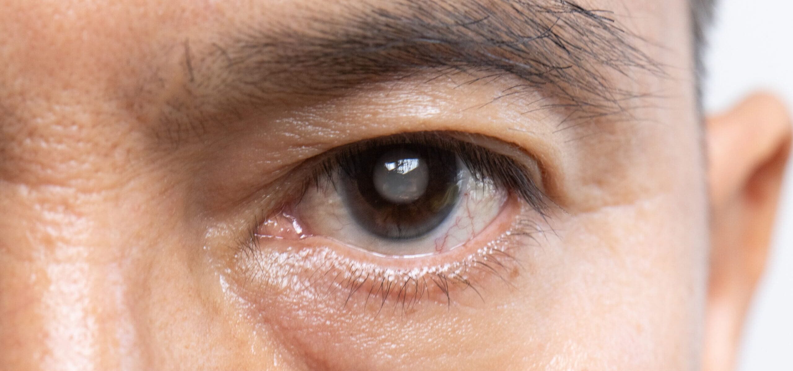What Is Glaucoma? Plus, Learn About Causes, Types & Treatment