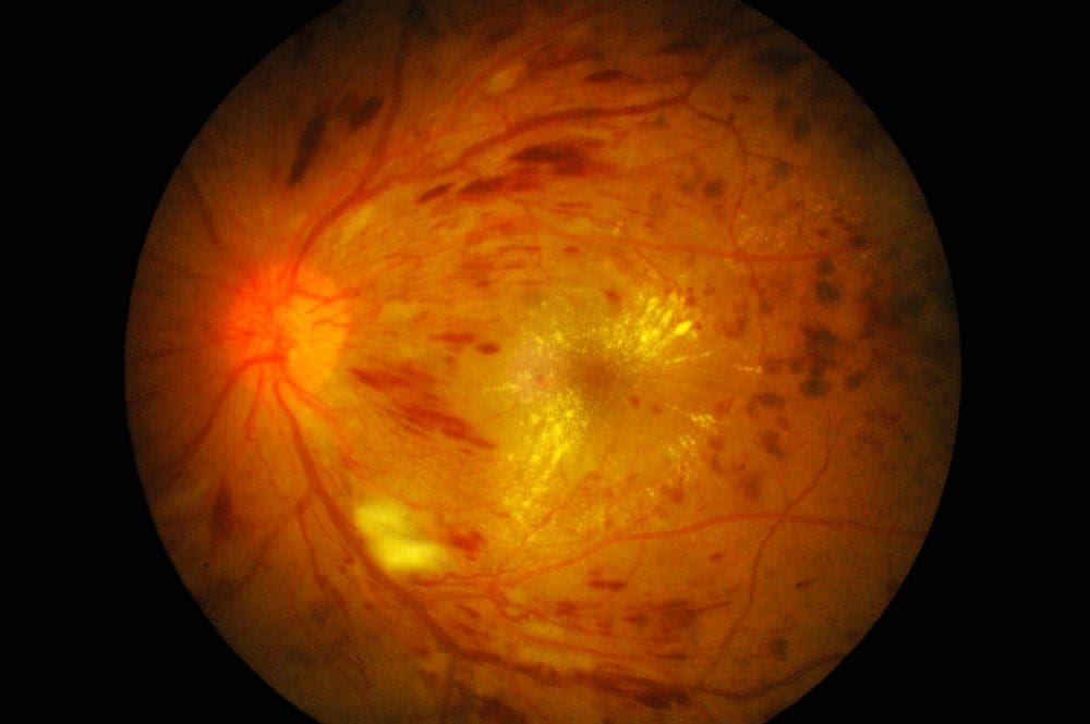 Diabetic macular ede...