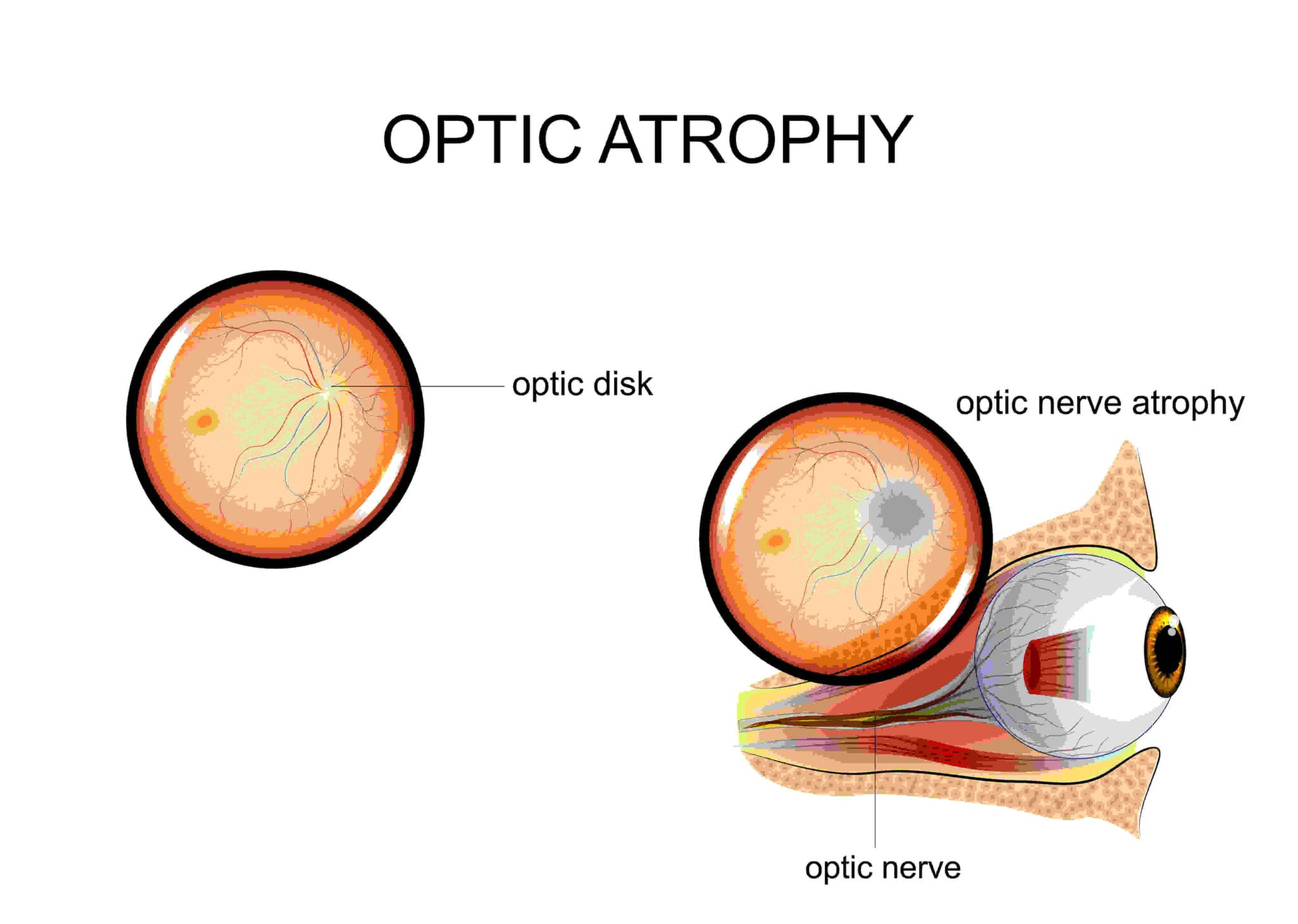 What Are The Signs Of Optic Atrophy And How Do You Reverse It Nvision Eye Centers 