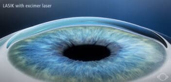 lasik animation
