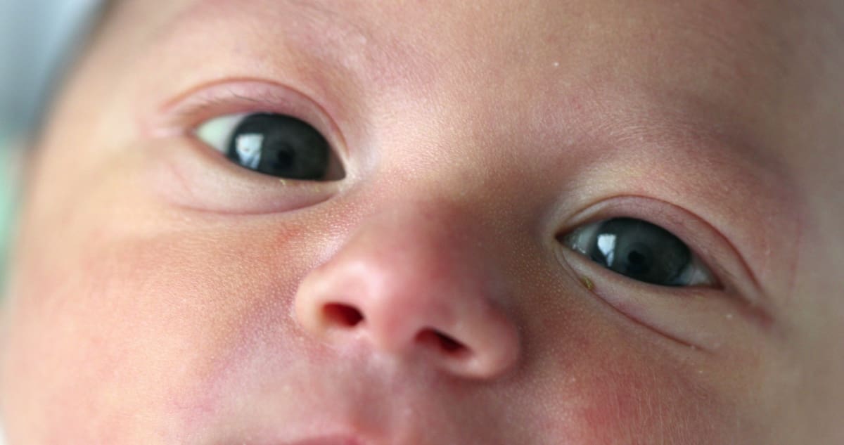Congenital Cataracts