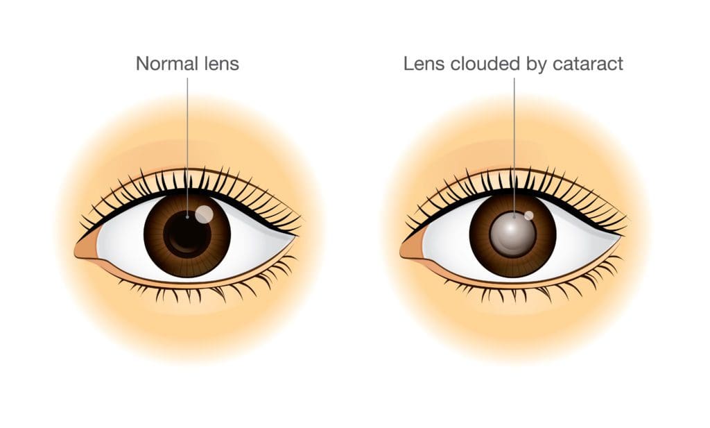 eye with and without cataracts