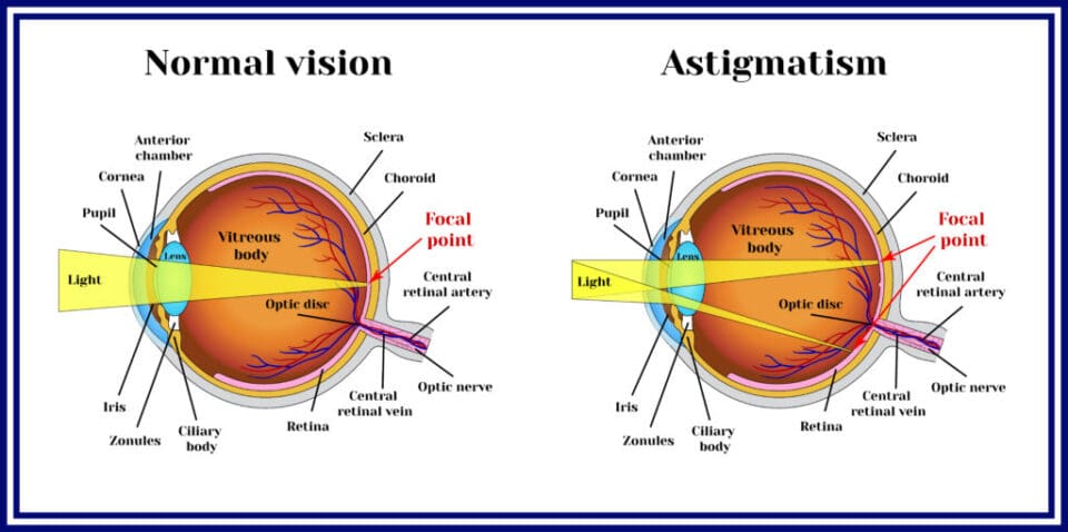 Astigmatism Eye