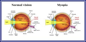 myopia graphic