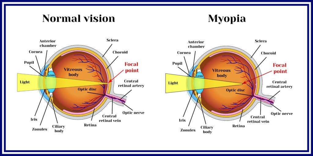 myopia graphic