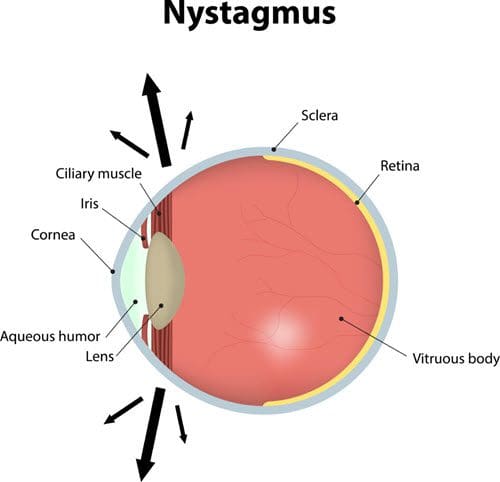 Nystagmus: Causes, Symptoms & Effective Treatment | NVISION Eye Centers