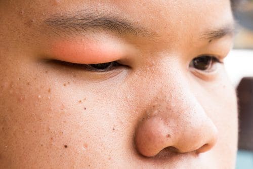 What causes puffy eyes?