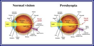 presbyopia diagram