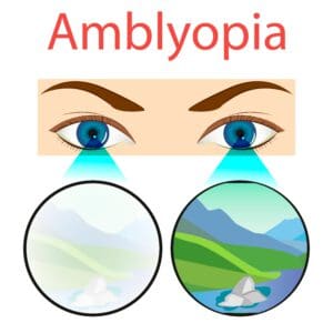 amblyopia látásélesség