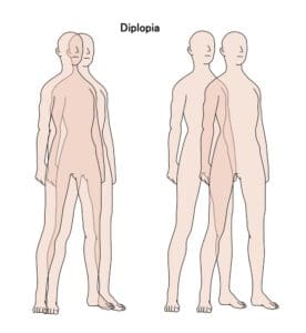 Diplopia: Causes and Treatments of Double Vision