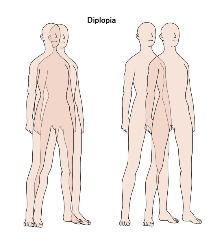 Diplopia Causes and Treatments of Double Vision