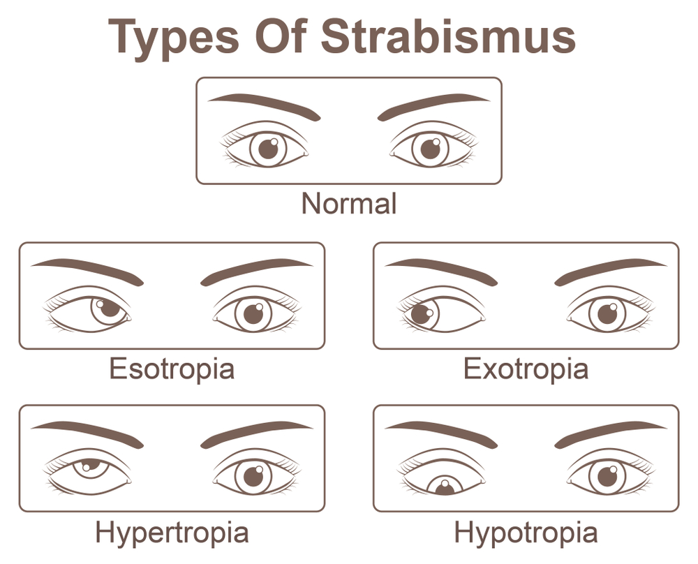 amblyopia látásélesség