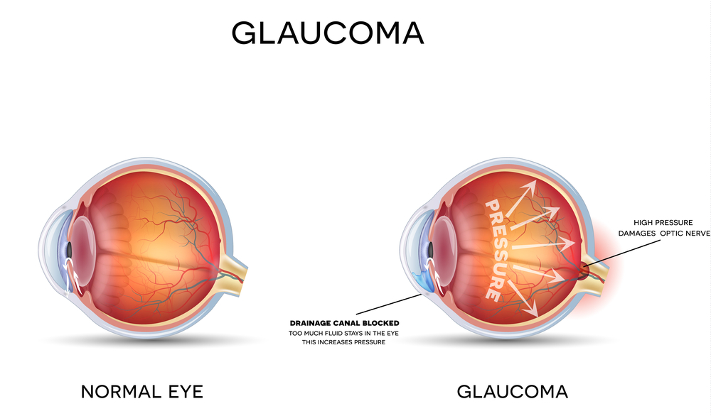 glaucom vizual tunel