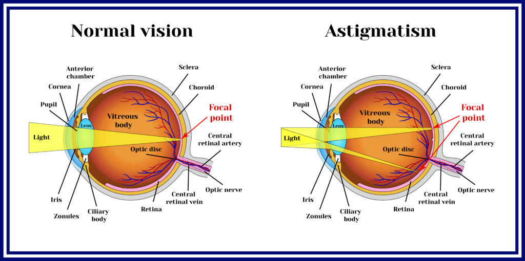 Lasik Singapore