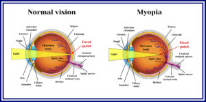 degenerative myopia myopia)