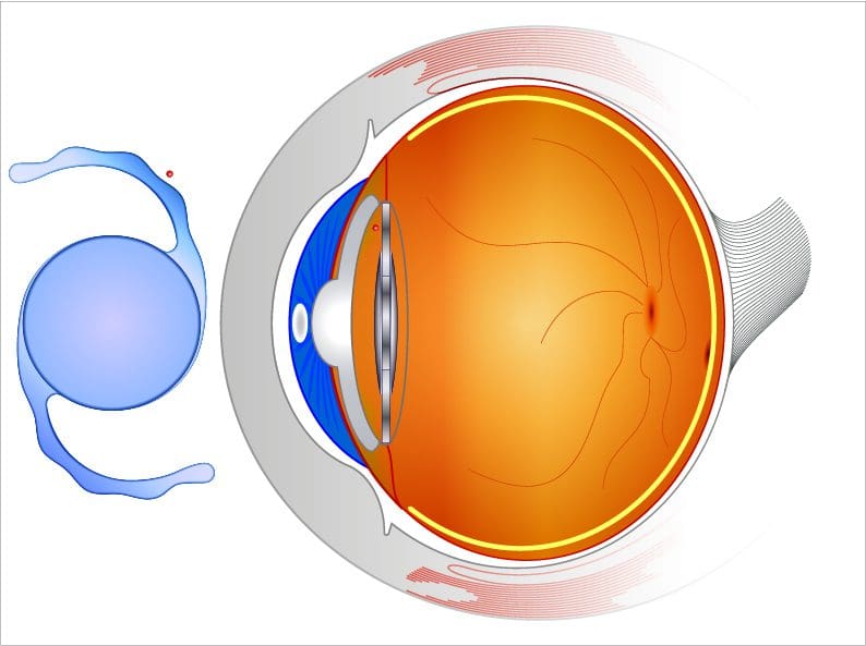 common-uncommon-cataract-surgery-complications-nvision-eye-centers