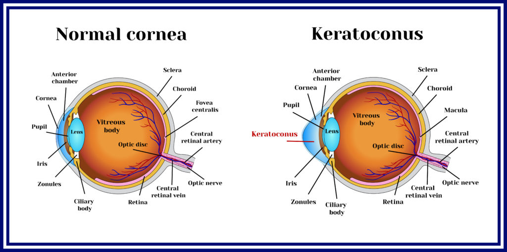 Types of Eye Surgery An Exhaustive Guide NVISION Eye Centers